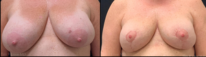 Patient is one month post mastopexy.-before