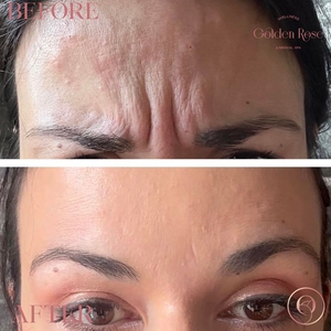 Botox- Neuromodulators-before
