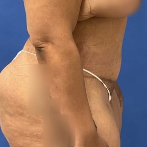 Tummy Tuck #12-after