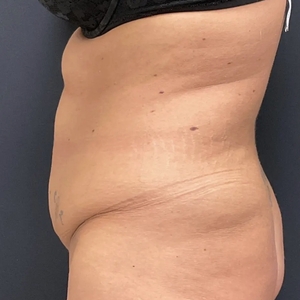 Tummy Tuck #10-before