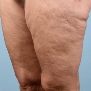 Cellulite Reduction #1-before