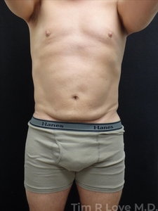 Abdominoplasty - Mini-before