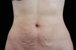 4 Treatments-after