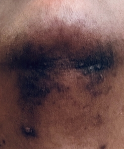 Hyperpigmentation of Chin-after