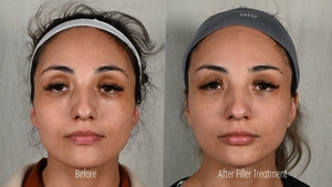 Filler ZB B/A Frontal-before