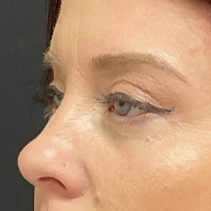 Brow & Eye Lift #4-after