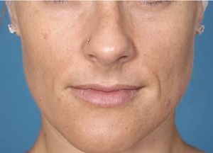 Hyperpigmentation-after