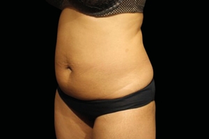 2 Weeks after last treatment-before