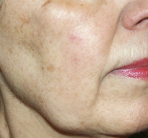 Actinic Elastosis-after