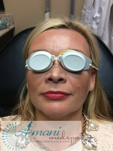 Right after treatment & 1 day after-after