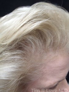 5 months post op-before