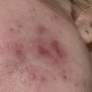 Laser Resurfacing #3-before