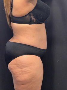 Lipo 360 + mini tummy tuck-after