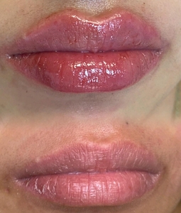 Lip Fillers-before