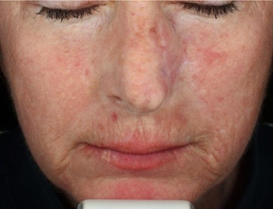 Skin Tone & Texture-after