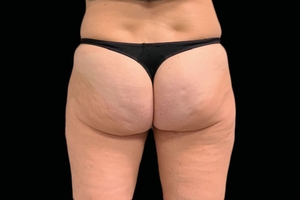 4 Treatments-before