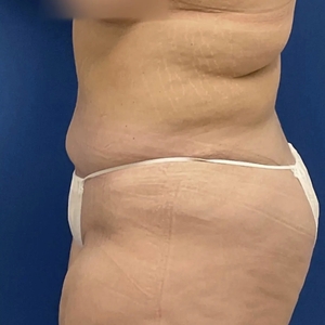 Tummy Tuck #14-after