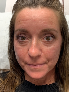 Tear trough Filler volbella-before