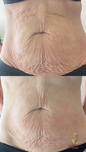 One XERF Treatment-before