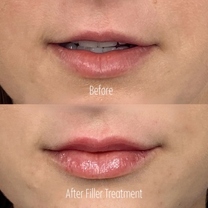 Filler B/A SBA 26-before