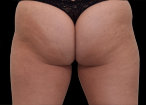 Emsculpt NEO #3-before