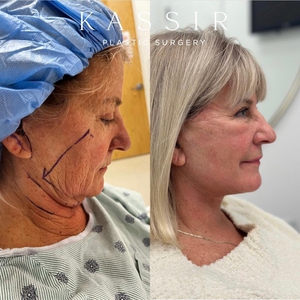 Revision Face & Neck Lift and CO2 Laser-after