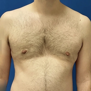 Male Breast Reduction #5 (front)-after