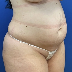 Lipo w Renuvion #8-before