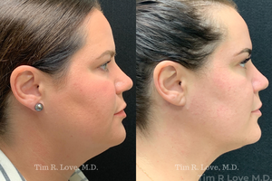 1 month post op MyEllevate, FaceTite, Morpheus8, and Sculptra-before