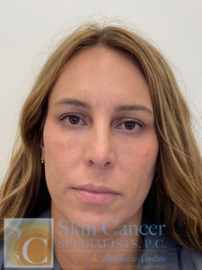 Under Eye Rejuvenation and IPL-after