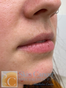 lip filler-before