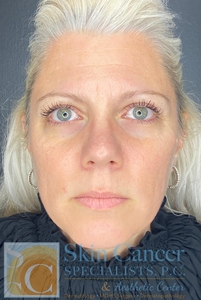 Lip Filler and Dysport-before