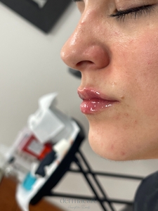 Tori Atkins RN. Volbella-after