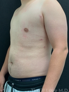 2 month post op BodyTite on chest to eliminate Gynecomastia-after