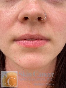 lip filler-before