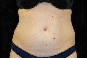 4 Treatments-before
