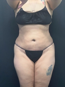 LAL 360 + mini tummy tuck-before