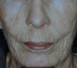 Actinic Keratosis, Lentigines & Wrinkles-before
