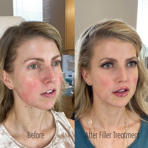 Filler B/A SBA 12-before