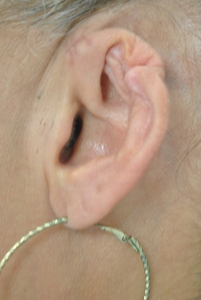 Ear Reconstruction-before