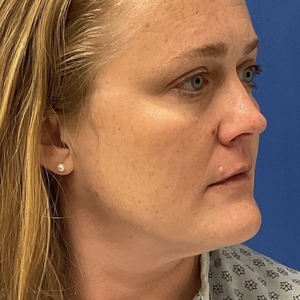 Lipo w Skin Tightening Face #7-after