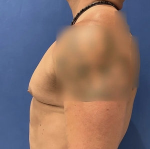 Male Breast Reduction #4 (left)-before