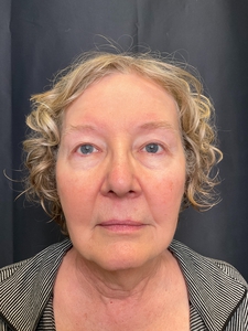 NECK AND LOWER FACE-before