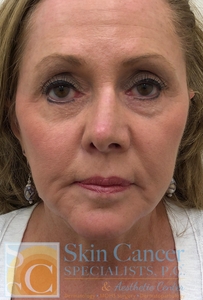 Fraxel and Filler-after