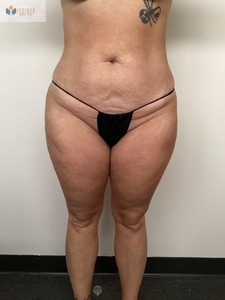 2 insta abd treatments-before