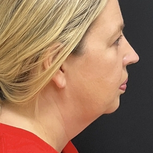 Lipo w Skin Tightening Face #3-before