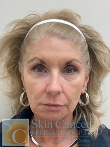 Cheek Filler, Around Mouth Filler and Botox-after
