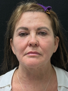 1 syringe of Kysse-after