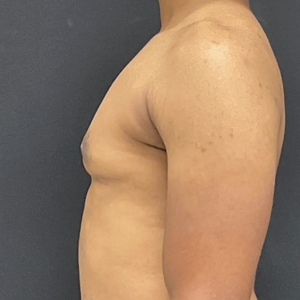 Lipo w BodyTite #9-after