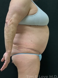 Abdominoplasty - Traditional-after